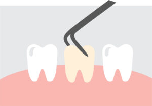 Image depicting a tooth extraction due to an infection. 